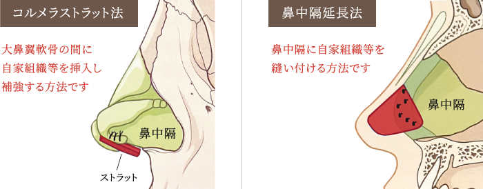 コルメラストラット法と鼻中隔延長の比