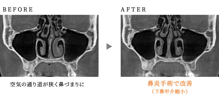 鼻炎手術で改善