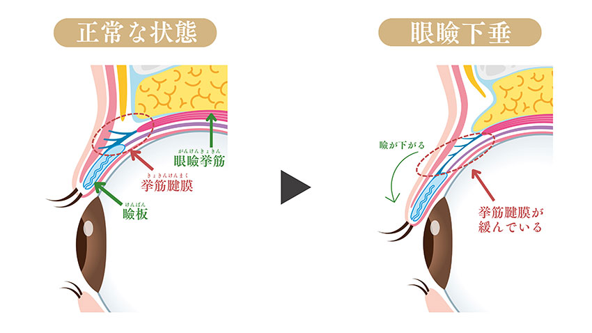 正常な状態と眼瞼下垂