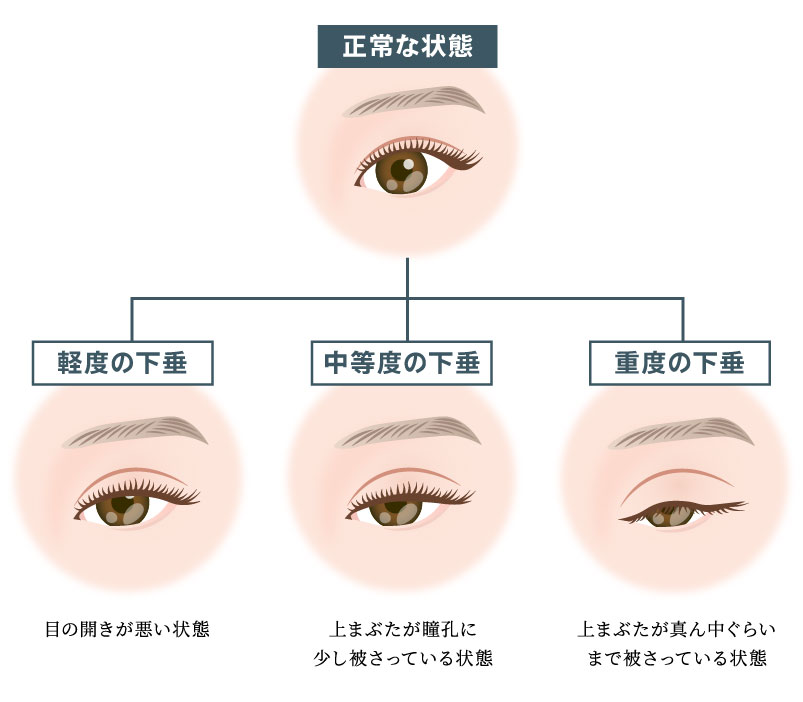 眼瞼下垂の症状イラスト