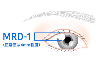 MRD：角膜反射（瞳孔中央）と上眼瞼緑の距離に注目し瞳孔に瞼が被っていく程度で評価。