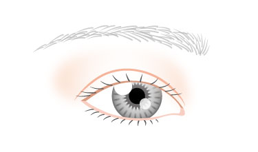 軽度の眼瞼下垂症（2mm下がり）