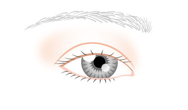 中等度の眼瞼下垂症（3mm下がり）