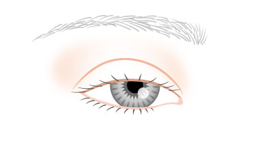 重度の眼瞼下垂症（4mm下がり）