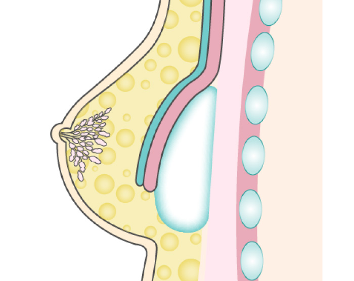 デュアルプレーン法