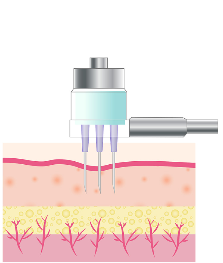 吸引圧によりニードルが肌に刺さる