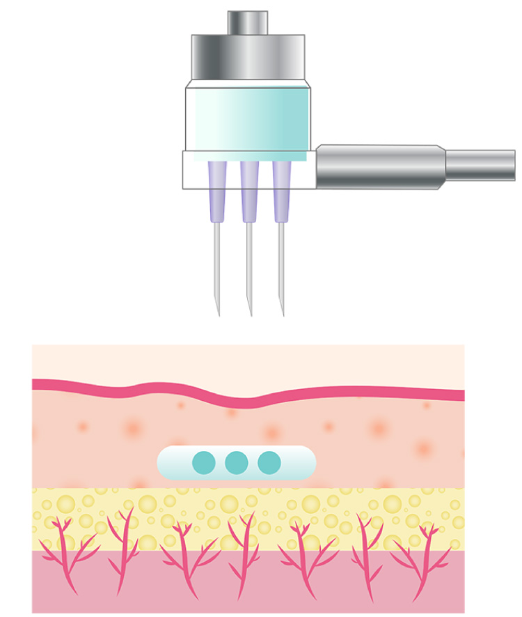 針が刺さったことによる一時的な傷ができ、創傷治癒反応でさらに美肌効果が期待されます