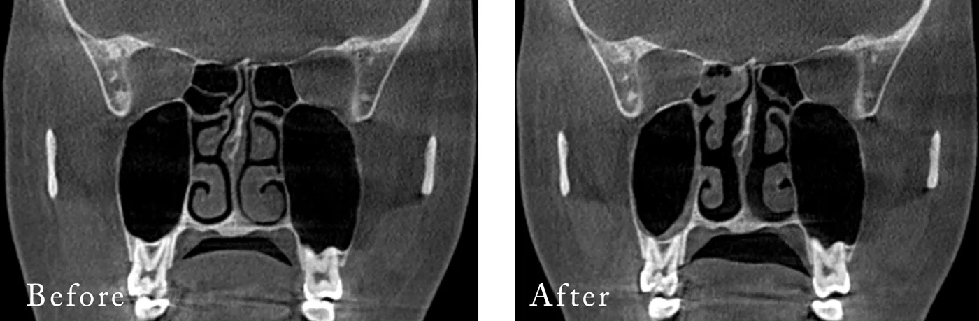 下鼻甲介縮小（鼻炎手術）を行った方のCT