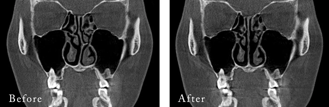 鼻中隔湾曲修正を行った方のCT
