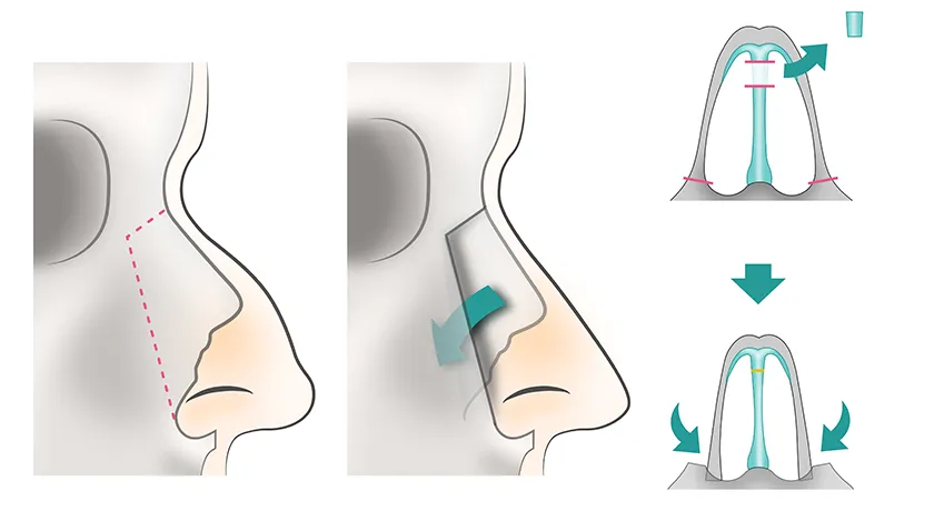 プッシュダウン法