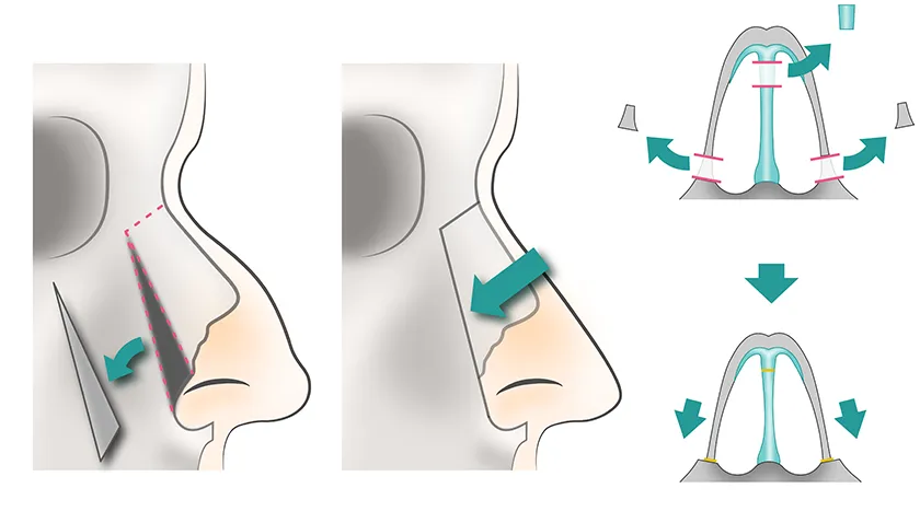 レットダウン法
