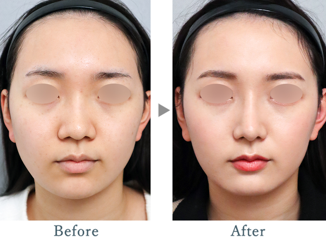 鼻筋＆鼻尖 Simple nose ｜ ザ・プラス美容外科 東京代官山 名古屋