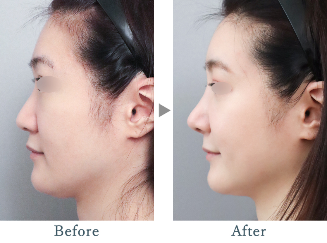 鼻筋＆鼻尖(Simple nose)+骨切り幅寄せ+鼻炎手術+貴族手術(プロテーゼ
